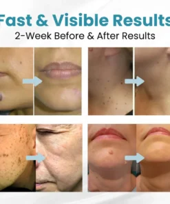 Tnnedey®Non-Invasive Skin Imperfection Removal Pen