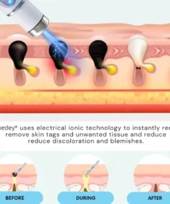 Tnnedey®Non-Invasive Skin Imperfection Removal Pen
