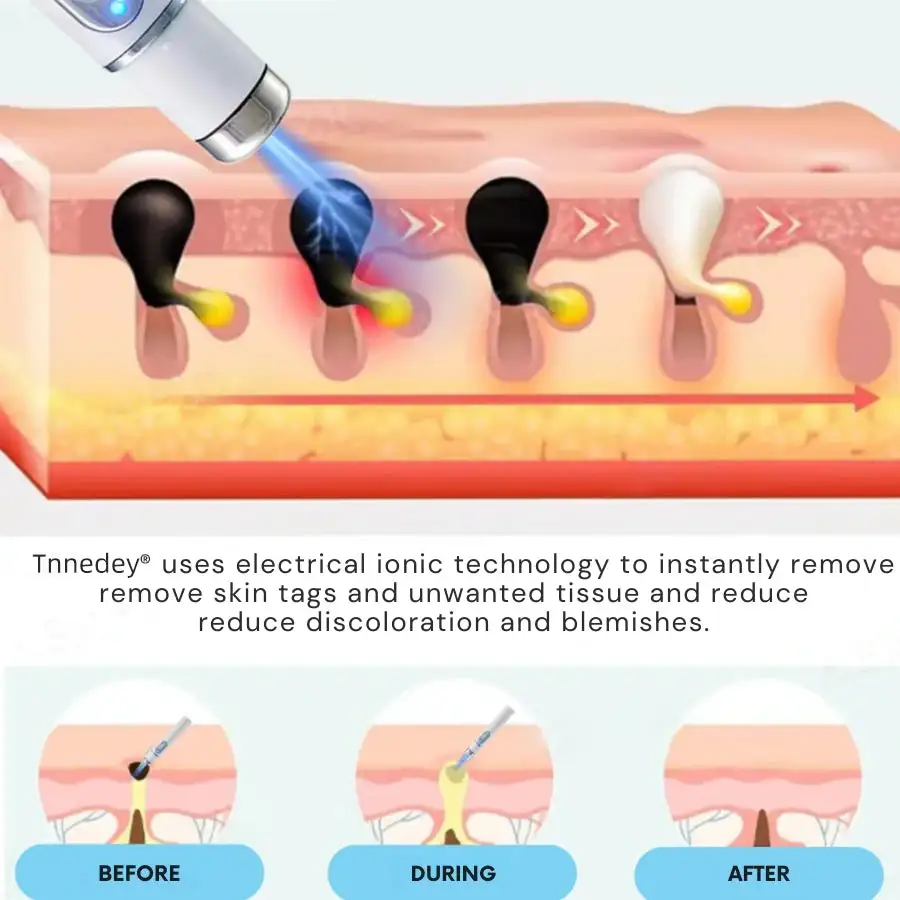 Tnnedey®Non-Invasive Skin Imperfection Removal Pen