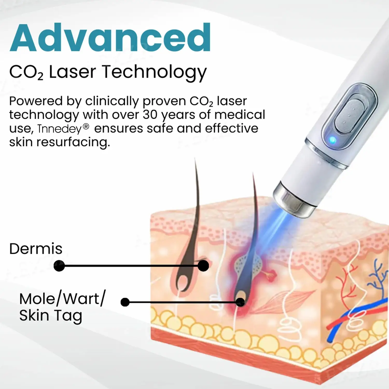 Tnnedey®Non-Invasive Skin Imperfection Removal Pen